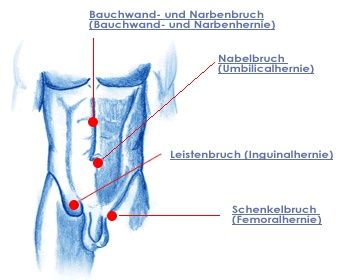 Hernieart - Dr. Hunsicker-Schneider Viszeralchirurgie Zürich in Zürich